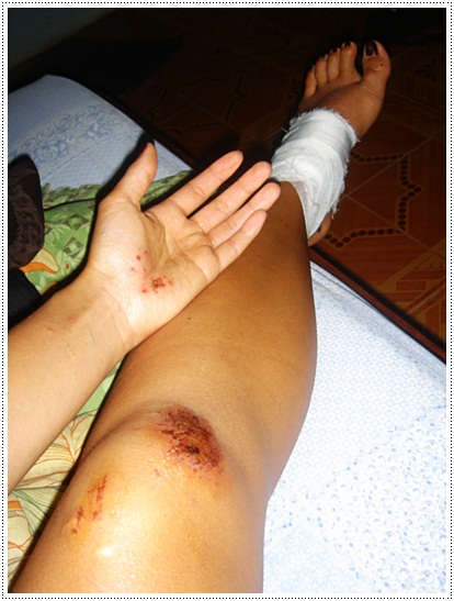 Injured after a moped accident in Pai, Thailand
